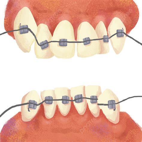 Orthodontic Braces Png Picture Tooth Braces Orthodontics Orthodontics