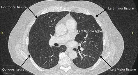 A Patient With ‘left Middle Lung Lobe