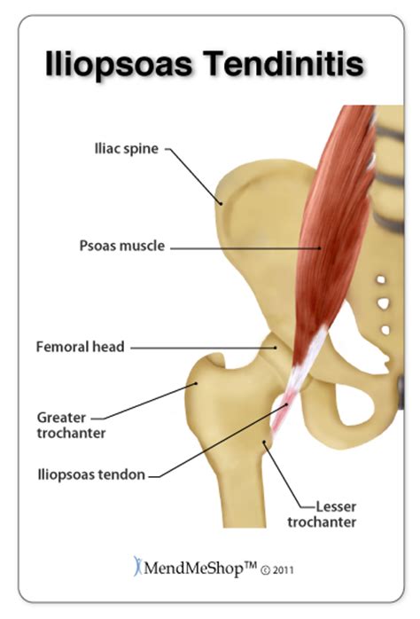 Flexor tendon injury repair has been extensively researched and the literature demonstrates successful repair requires minimal gapping at the repair site or interference with tendon vascularity. Hip Flexor Strain-Tear