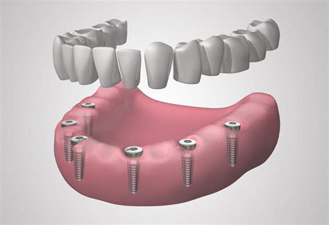 Implantes Dentales Dental Vallès