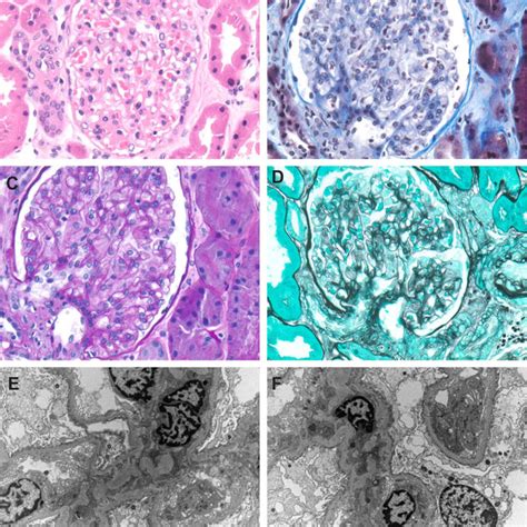 Class Iib Lupus Nephritis Note Immunofluorescence Microscopy Showing