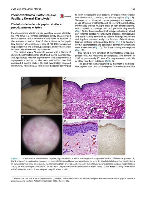 Pdf Pseudoxanthoma Elasticumlike Papillary Dermal Elastolysis