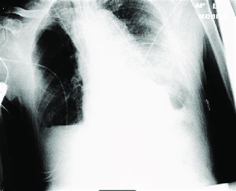 Chest Radiograph Of Mr X Taken Post Operatively Showing Pleural