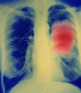Lung cancer - Stock Image - M134/0228 - Science Photo Library Lung Cancer  