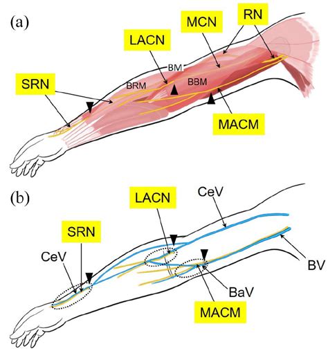 Cutaneous Nerve Conscious Surgical Repair Of Vascular Access Related