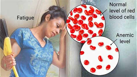 Understanding Anemia Symptoms Types Diagnosis And Treatment Womenyeah
