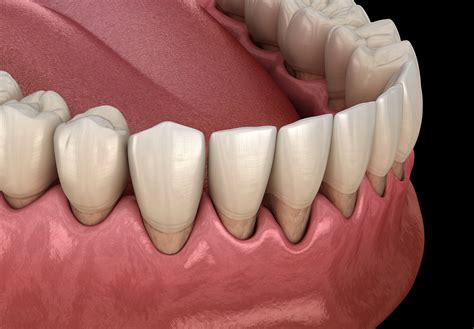 Sensitive Tooth And Tooth Root Exposure