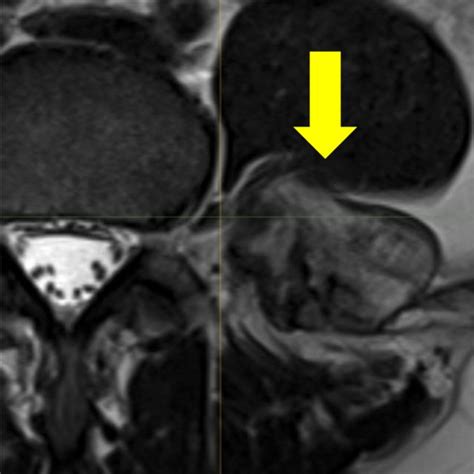 Mri Demonstrating The L3 Nerve Root Anterior To The Osteochondroma
