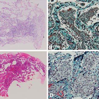 Transbronchial Lung Biopsy Pathology Evaluation In Patients With The