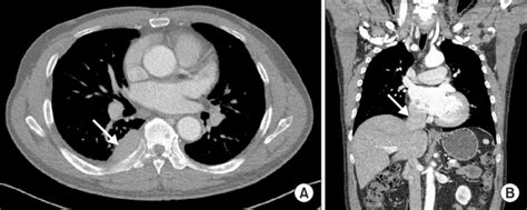 What Is A Ct Scan With Contrast For Chest