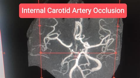 Occlusion Of Internal Carotid Artery MRI YouTube