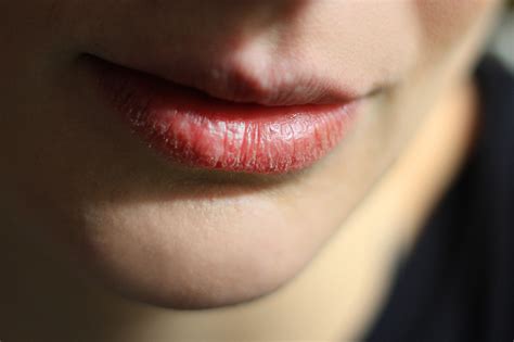 Herpes On Lips Causes Cheap Store Save 61 Jlcatjgobmx