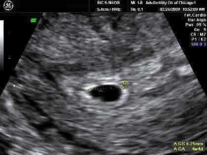 You can get an ultrasound at any time, pregnant or not. 5 Week Ultrasound Pictures | New Health Advisor
