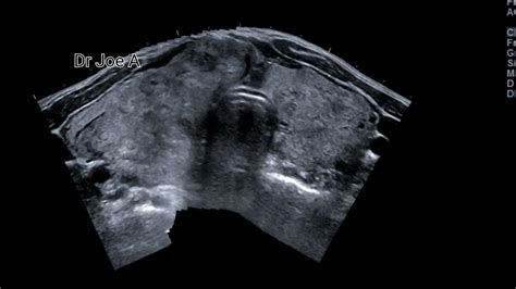 Huge Multinodular Goiter Of Thyroid Ultrasound And Color Doppler Video