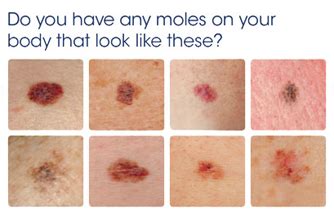What causes basal cell carcinoma? THC & CBD May Decrease Viability of Melanoma Cells ...