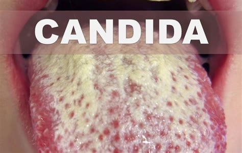 Candidiasis Causas Sintomas Y Tratamientos Con Remedios Caseros