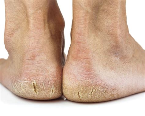 Cracked Heels Dry Skin And Heel Fissures Ottawa Foot Clinic