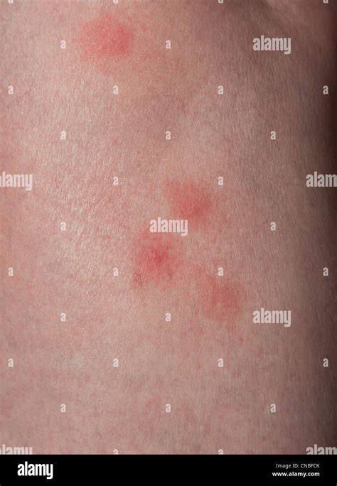 Redness And Tick Bite Marks On The Skin Stock Photo Download Image Now