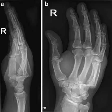 X Ray Right Hand Ap And Oblique Test Price In Delhi Ganesh Diagnostic