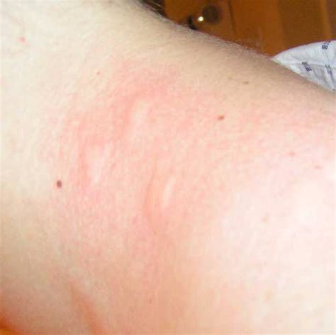 Bed Bug Bites Pictures On Brown Skin