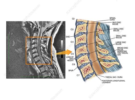 Bulging Discs In The Cervical Spine Stock Image C0210232 Science