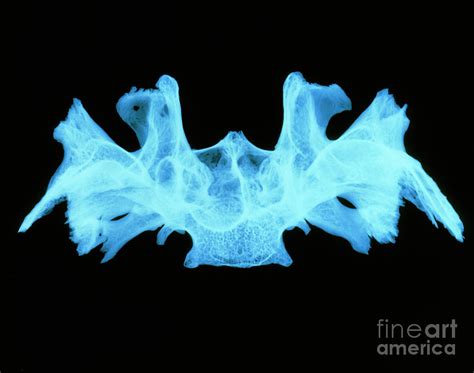 X Ray Image Of A Human Sphenoid Bone Photograph By D Robertsscience