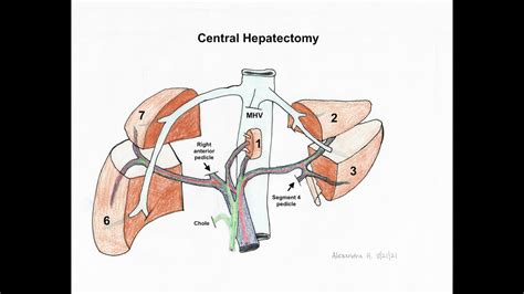 Robotic Anatomic Central Hepatectomy For Large Hcc Narrated