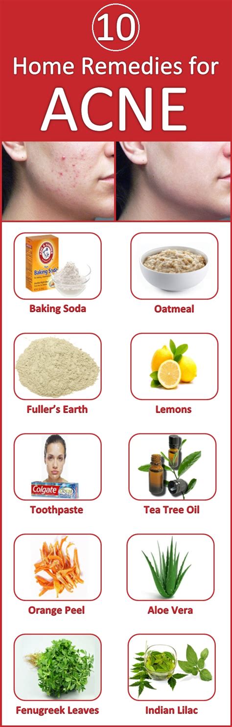 Home Remedies For Acne
