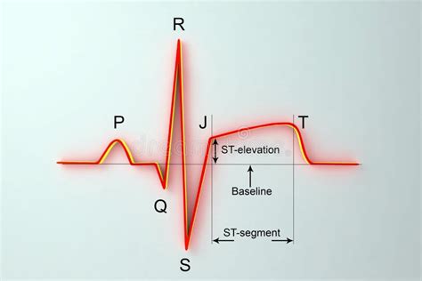 Ecg No Enfarte Do Miocárdio Ilustração Que Mostra A Elevação Do St