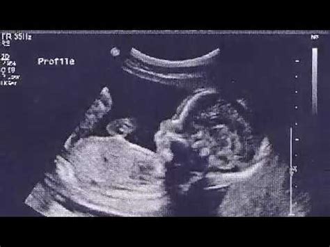 Baby At 8 Months Pregnant Girl Shefalitayal