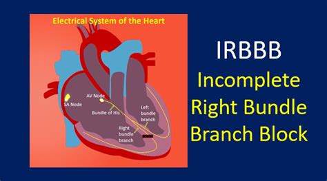 What Is IRBBB All About Heart And Blood Vessels