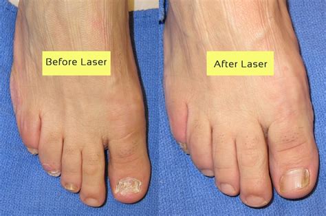 Cutera Laser For Nail Fungus Before And After Pictures Toenail Fungus