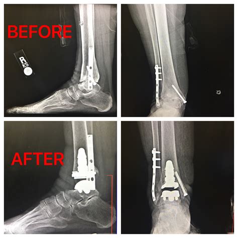 Patient Success Story Total Ankle Replacement The Orthopaedic Group Pc