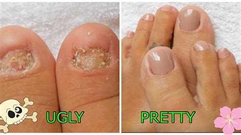 Polygel Toenails W Dual Forms On Toes With No Nails Beginner