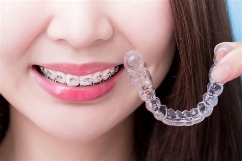 Invisalign Vs Braces The Pros And Cons Schaumburg Dentistry