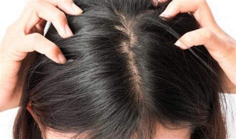 How To Treat Scalp Zits According To Experts
