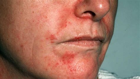 Dermite Ou Dermatite De Contact Aperçu Définition Cause Symptômes Traitement