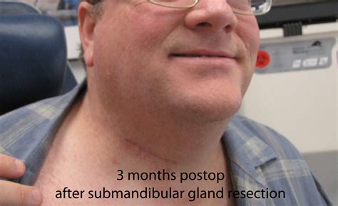 Case Example Of Submandibular Gland Resection With Sialendoscopy To