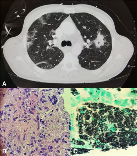 Progressive Disseminated Histoplasmosis With Concomitant Disseminated