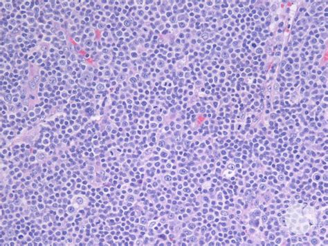 Node With Areas Of Small Lymphocytic Lymphoma