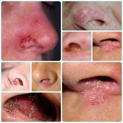 Collection 95 Pictures Herpes On The Nose Photos Stunning 102023