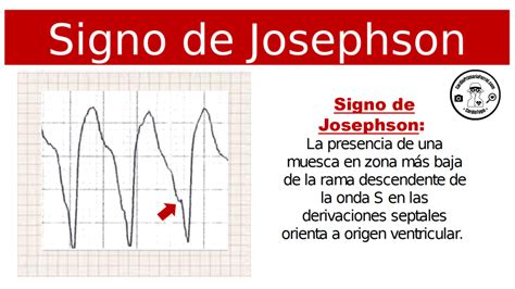 Cardiotruco Signo De Josephson Cardioprimaria Ferrol