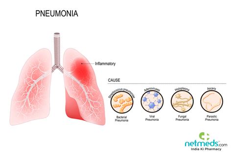 Pneumonia Know About The Types And The Various Treatment Options