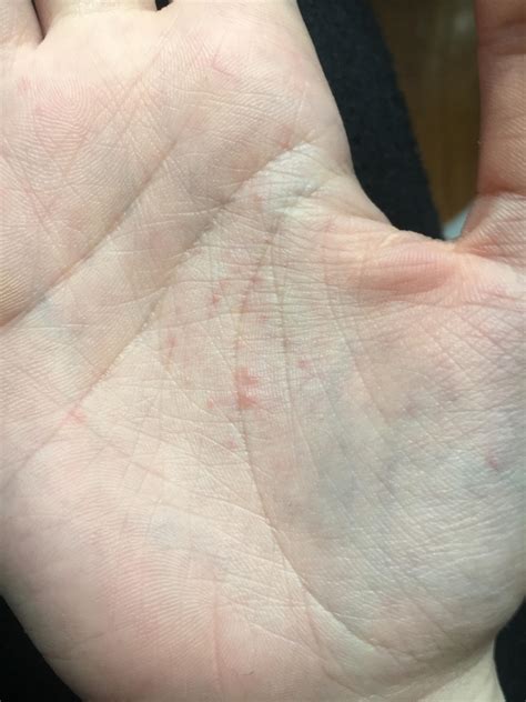 What Is On My Palms Eczema Theyre Red And Itchy And On Both Palms I Have Touched No Strange