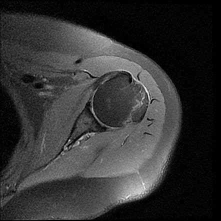 Humeral Greater Tuberosity Avulsion Fracture Radiology Case