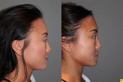 🥇 Atlanta Non Surgical Nose Job Georgia Liquid Rhinoplasty