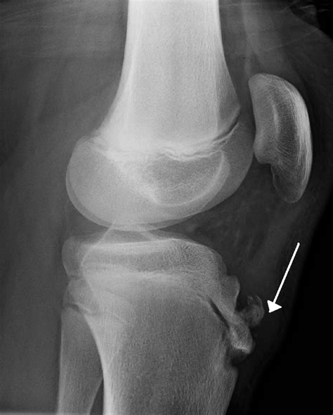 Blog De José Carlos Mora Enfermedad De Osgood Schlatter