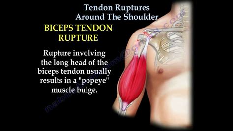 Tendon Ruptures Around The Shoulder Everything You Need To Know Dr