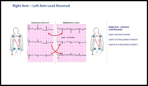 T19 Lead Errors Ecg Made Simple