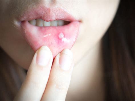 How To Treat Boil On Lip